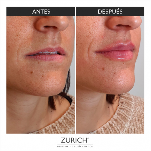 Antes y despu�s aumento de labios